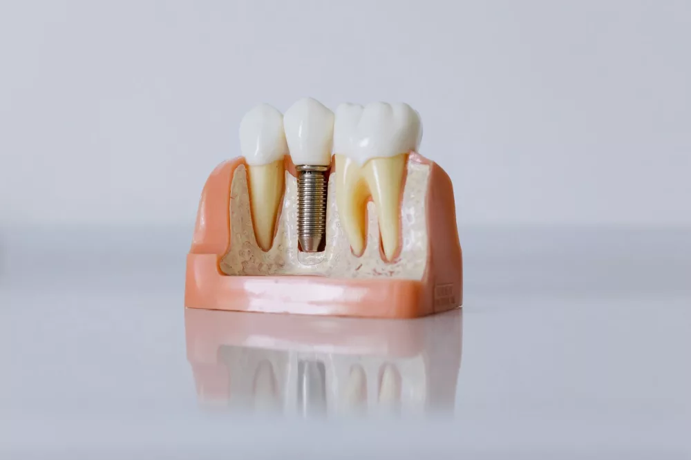 Dental Implants: Your Comprehensive Guide to Restoring Your Smile and Confidence